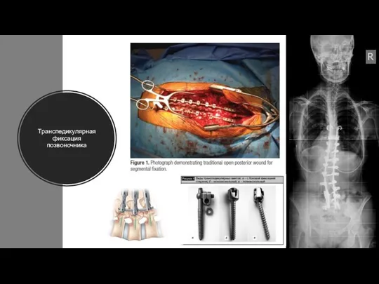 Транспедикулярная фиксация позвоночника
