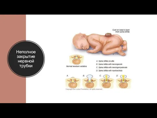 Неполное закрытие нервной трубки