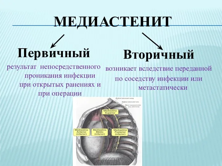 МЕДИАСТЕНИТ Первичный результат непосредственного проникания инфекции при открытых ранениях и при операции