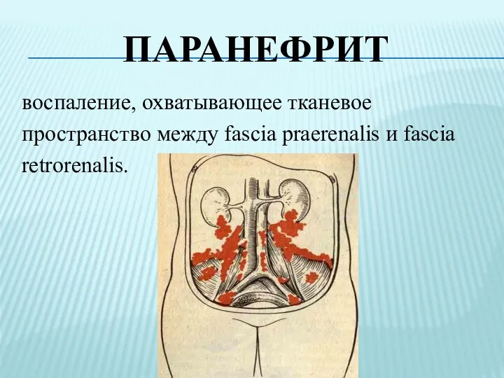 ПАРАНЕФРИТ воспаление, охватывающее тканевое пространство между fascia praerenalis и fascia retrorenalis.
