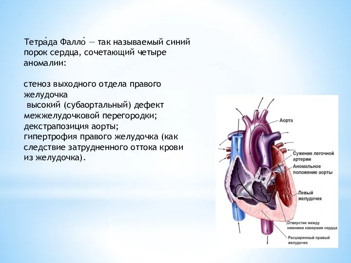 Тетра́да Фалло́ — так называемый синий порок сердца, сочетающий четыре аномалии: стеноз