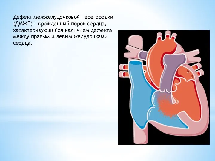 Дефект межжелудочковой перегородки (ДМЖП) - врожденный порок сердца, характеризующийся наличием дефекта между