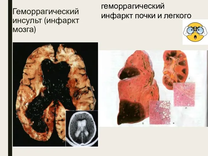 Геморрагический инсульт (инфаркт мозга) геморрагический инфаркт почки и легкого