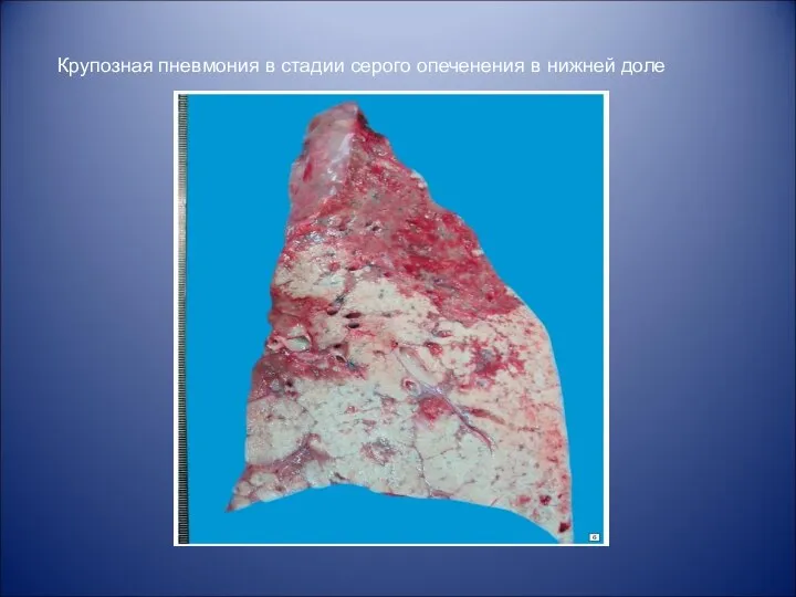 Крупозная пневмония в стадии серого опеченения в нижней доле