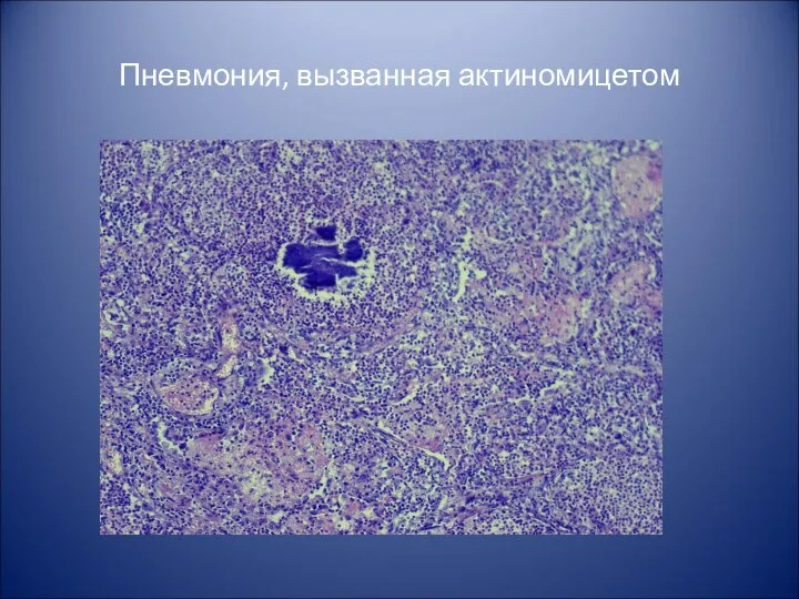 Пневмония, вызванная актиномицетом