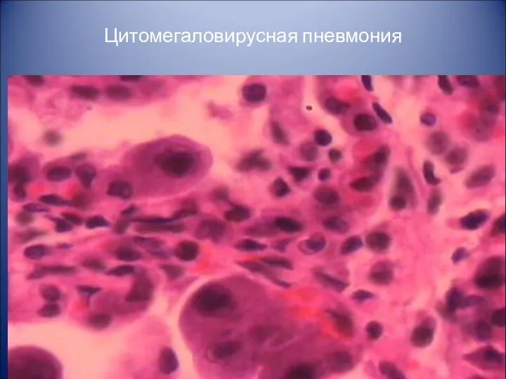 Цитомегаловирусная пневмония