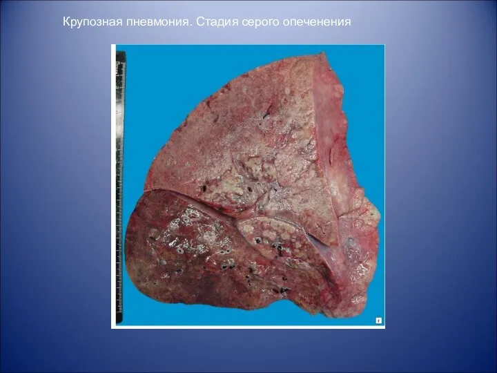 Крупозная пневмония. Стадия серого опеченения