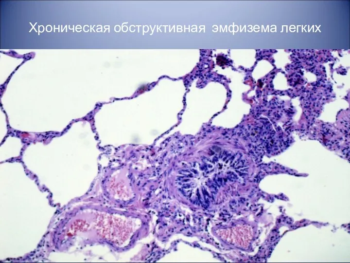 Хроническая обструктивная эмфизема легких