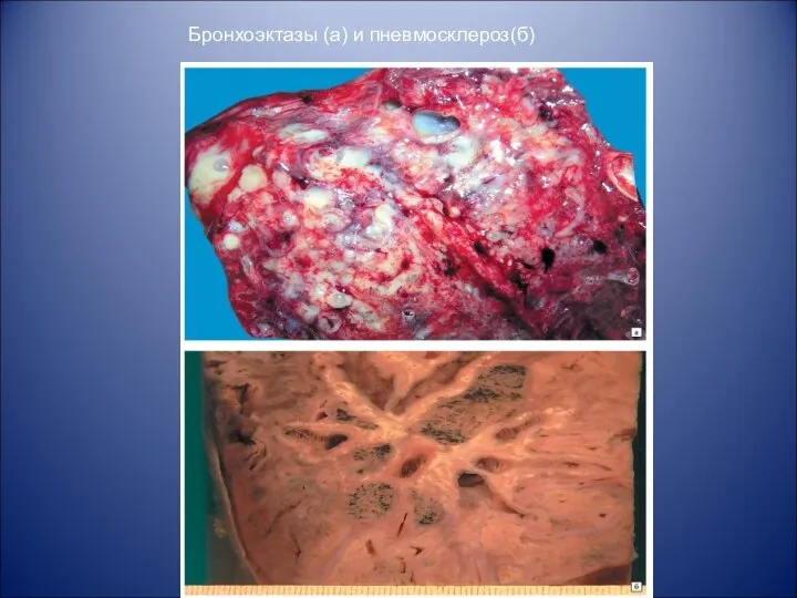 Бронхоэктазы (а) и пневмосклероз(б)