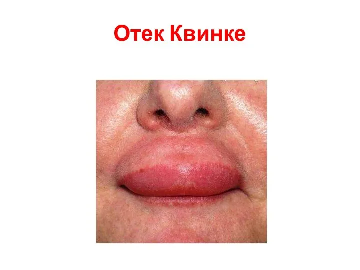 Отек Квинке