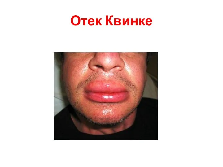 Отек Квинке