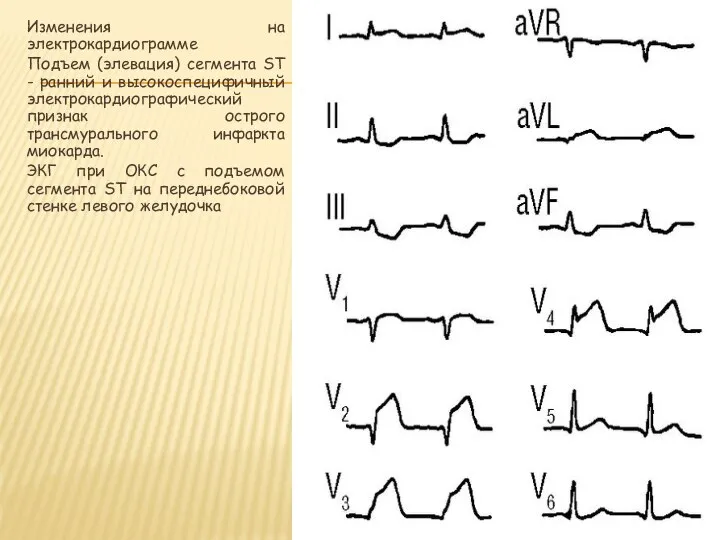 Изменения на электрокардиограмме Подъем (элевация) сегмента ST - ранний и высокоспецифичный электрокардиографический