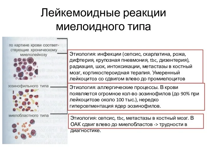 Лейкемоидные реакции миелоидного типа Этиология: инфекции (сепсис, скарлатина, рожа, дифтерия, крупозная пневмония,