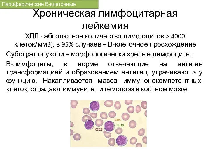Хроническая лимфоцитарная лейкемия ХЛЛ - абсолютное количество лимфоцитов > 4000 клеток/мм3), в