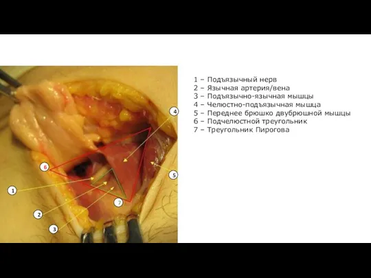 1 2 3 4 5 6 7 1 – Подъязычный нерв 2