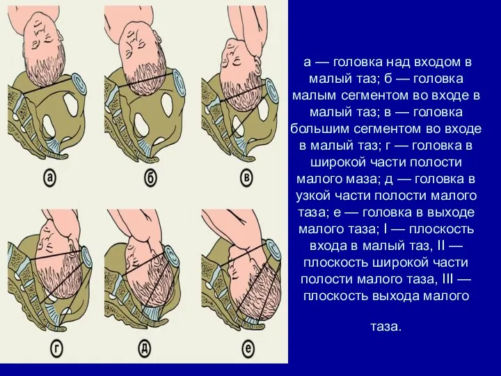 а — головка над входом в малый таз; б — головка малым