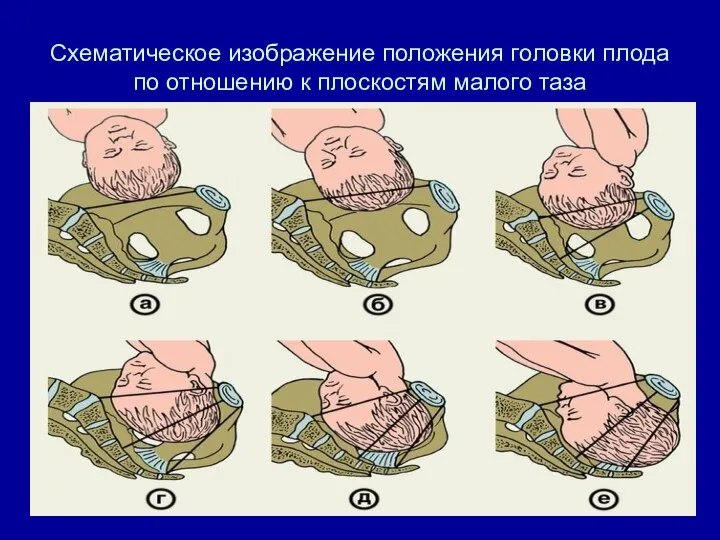 Схематическое изображение положения головки плода по отношению к плоскостям малого таза