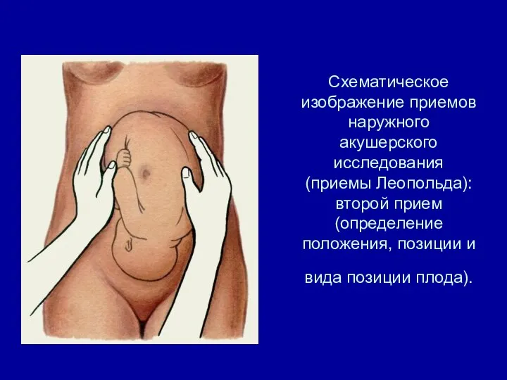 Схематическое изображение приемов наружного акушерского исследования (приемы Леопольда): второй прием (определение положения,