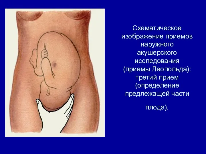 Схематическое изображение приемов наружного акушерского исследования (приемы Леопольда): третий прием (определение предлежащей части плода).