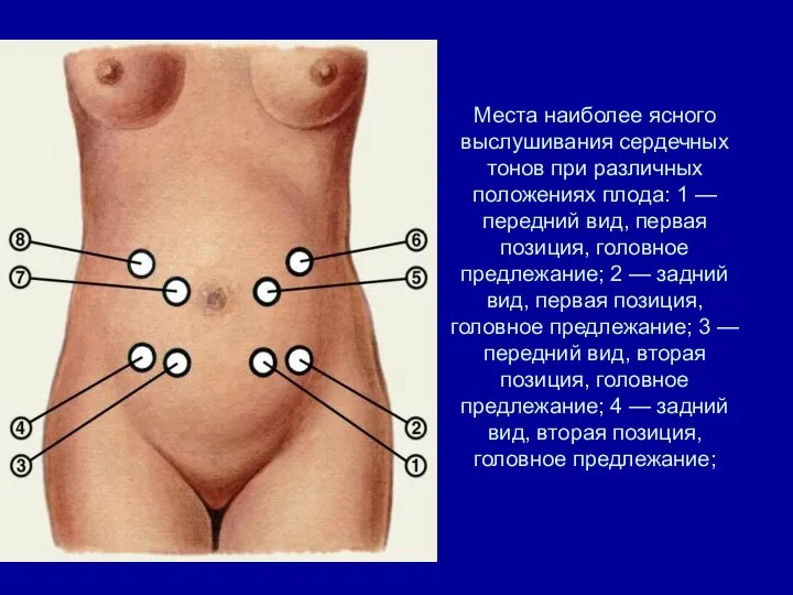 Места наиболее ясного выслушивания сердечных тонов при различных положениях плода: 1 —