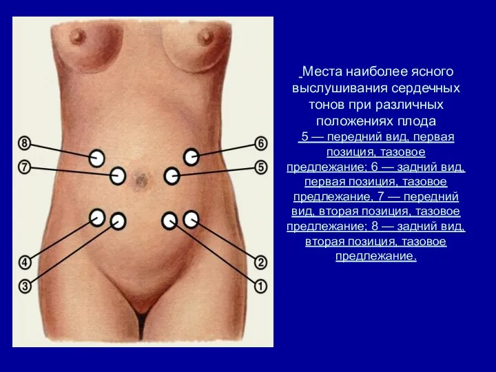 Места наиболее ясного выслушивания сердечных тонов при различных положениях плода 5 —