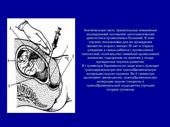 Значительную часть пренатальных инвазивных исследований составляет цитогенетическая диагностика хромосомных болезней. В этих