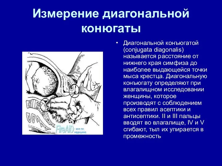 Измерение диагональной конюгаты Диагональной конъюгатой (conjugata diagonalis) называется расстояние от нижнего края