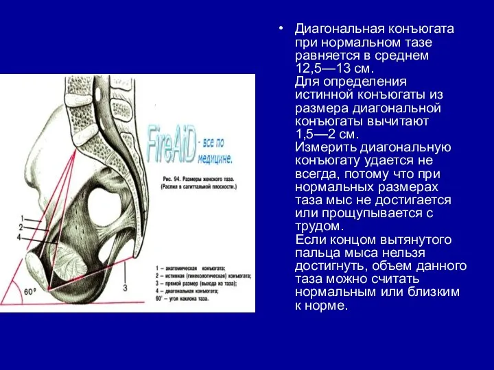 Диагональная конъюгата при нормальном тазе равняется в среднем 12,5—13 см. Для определения