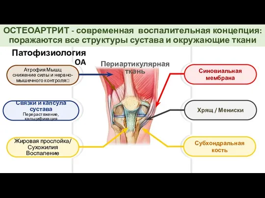 ОСТЕОАРТРИТ - современная воспалительная концепция: поражаются все структуры сустава и окружающие ткани