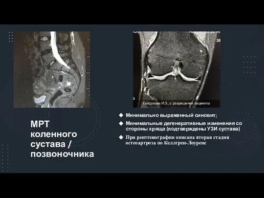 МРТ коленного сустава / позвоночника Минимально выраженный синовит; Минимальные дегенеративные изменения со