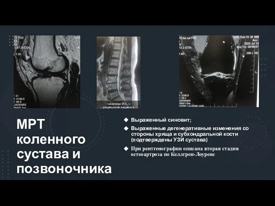 МРТ коленного сустава и позвоночника Выраженный синовит; Выраженные дегенеративные изменения со стороны