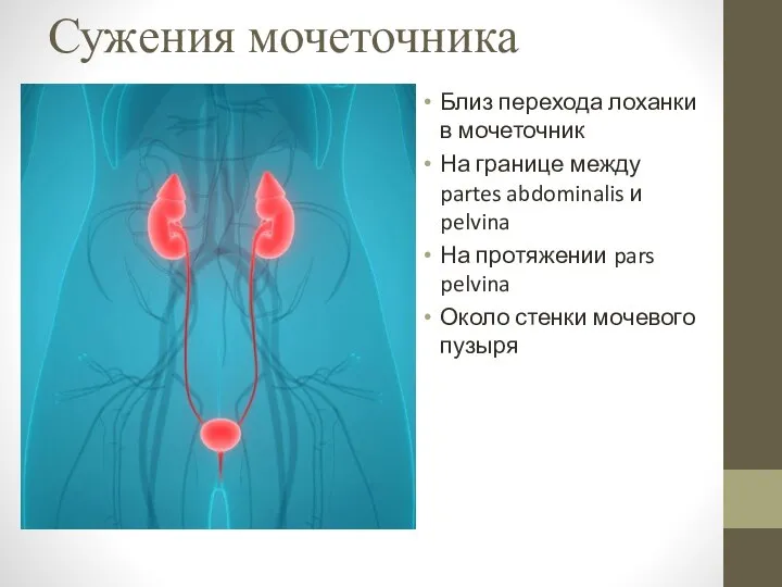 Сужения мочеточника Близ перехода лоханки в мочеточник На границе между partes abdominalis