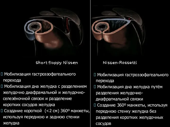 Мобилизация гастроэзофагеального перехода Мобилизация дна желудка путём разделения желудочно-диафрагмальной связки Создание 360º