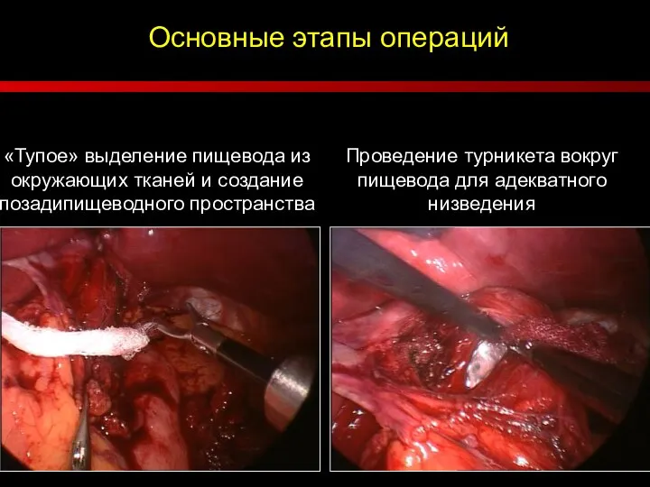 Основные этапы операций «Тупое» выделение пищевода из окружающих тканей и создание позадипищеводного