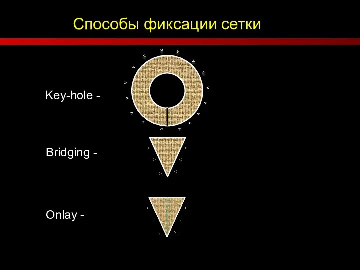 Способы фиксации сетки Key-hole - Bridging - Onlay - > > >