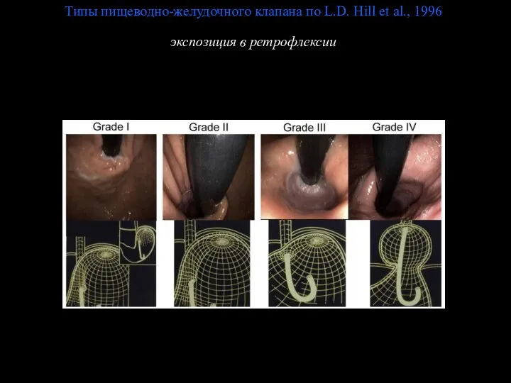 Типы пищеводно-желудочного клапана по L.D. Hill et al., 1996 экспозиция в ретрофлексии