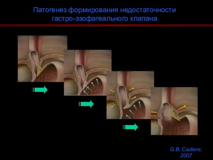 Патогенез формирования недостаточности гастро-эзофагеального клапана G.B. Cadiere, 2007