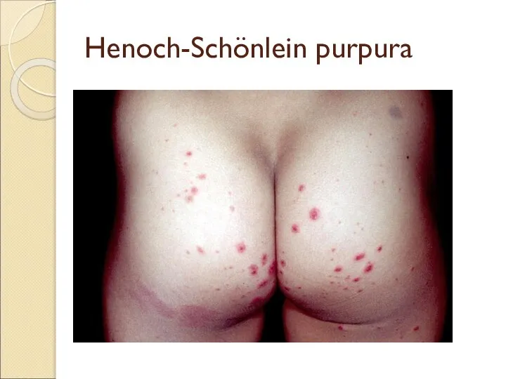 Henoch-Schönlein purpura