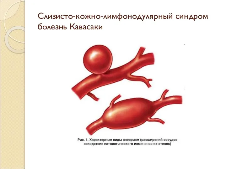 Слизисто-кожно-лимфонодулярный синдром болезнь Кавасаки