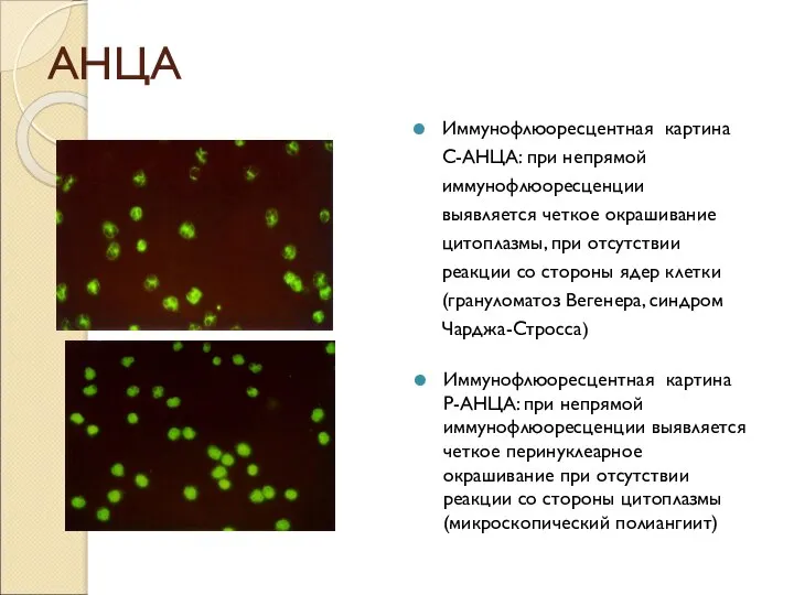 АНЦА Иммунофлюоресцентная картина C-АНЦА: при непрямой иммунофлюоресценции выявляется четкое окрашивание цитоплазмы, при