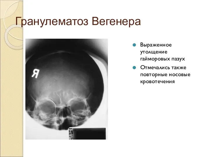 Гранулематоз Вегенера Выраженное утолщение гайморовых пазух Отмечались также повторные носовые кровотечения