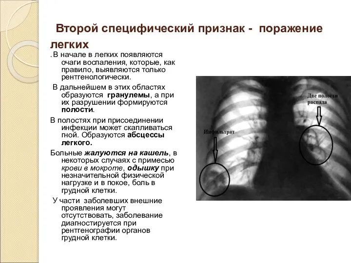 Второй специфический признак - поражение легких . В начале в легких появляются