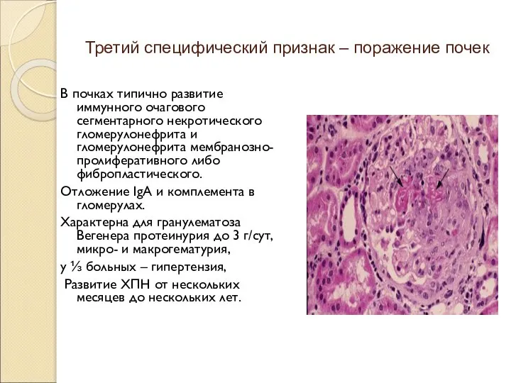 Третий специфический признак – поражение почек В почках типично развитие иммунного очагового