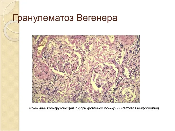 Гранулематоз Вегенера Фокальный гломерулонефрит с формированием полулуний (световая микроскопия)