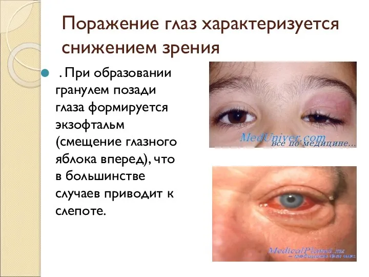 Поражение глаз характеризуется снижением зрения . При образовании гранулем позади глаза формируется