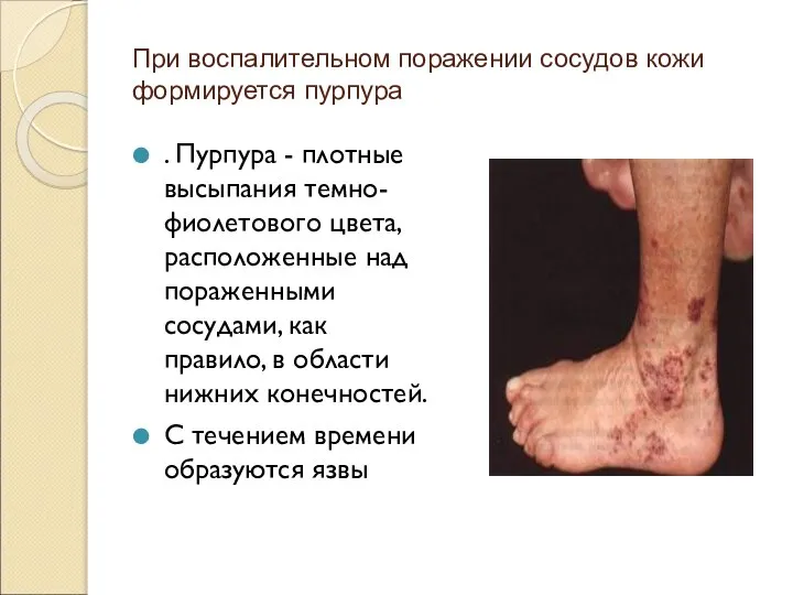 При воспалительном поражении сосудов кожи формируется пурпура . Пурпура - плотные высыпания