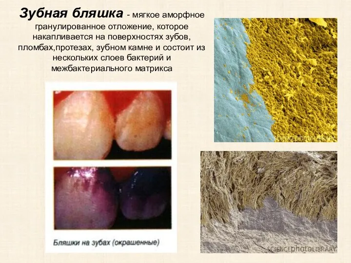 Зубная бляшка - мягкое аморфное гранулированное отложение, которое накапливается на поверхностях зубов,