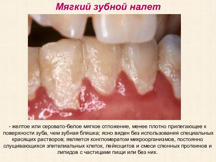 Мягкий зубной налет - желтое или серовато-белое мягкое отложение, менее плотно прилегающее