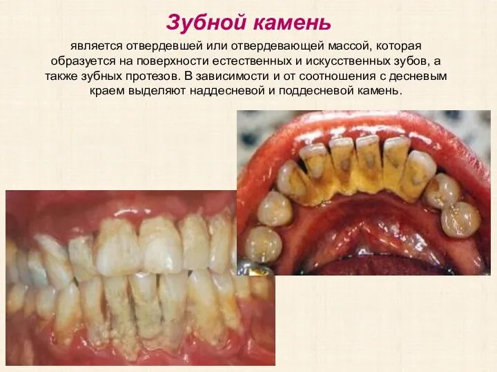 Зубной камень является отвердевшей или отвердевающей массой, которая образуется на поверхности естественных