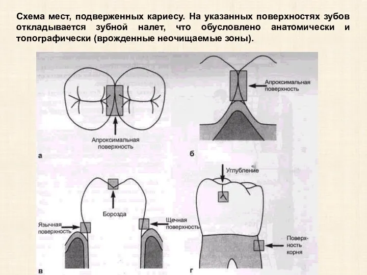 Схема мест, подверженных кариесу. На указанных поверхностях зубов откладывается зубной налет, что